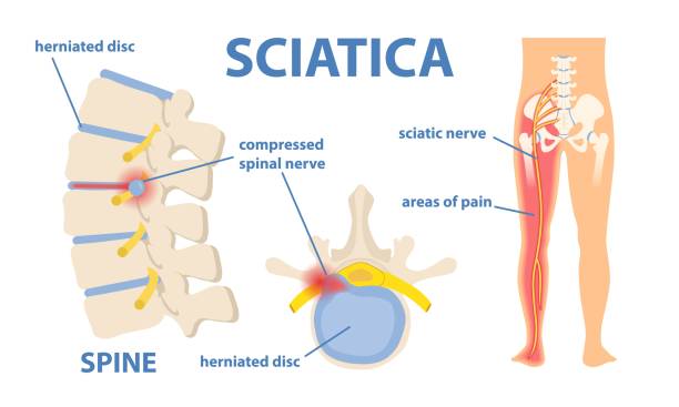 Sciatic nerve pain Sciatic nerve pain in the lower back through hip, thigh, knee to leg. Educational or informational poster. Flat vector medical illustration isolated on white background back pain stock illustrations