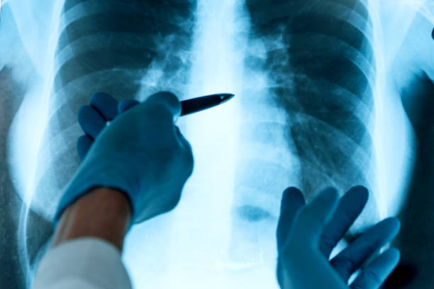close up. medical colleagues discussing an x-ray of the lungs stock photo
