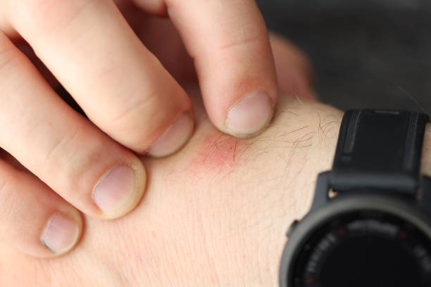 istock Man scratches red spot on wrist closeup 1325849149