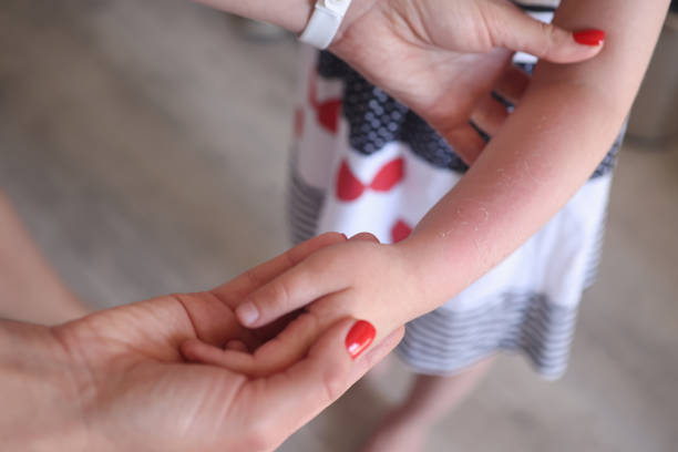 Sunburn redness and peeling of skin on child hand closeup Sunburn redness and peeling of skin on child hand. Baby sunburn and allergy concept sun exposure stock pictures, royalty-free photos & images