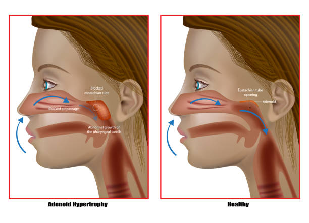 Adenoid hypertrophy, the abnormal growth of the pharyngeal tonsils. Adenoidectomy. Eustachian Tube Dysfunction Adenoid hypertrophy, the abnormal growth of the pharyngeal tonsils. Adenoidectomy or Adenoid Removal. Eustachian Tube Dysfunction tonsil stock illustrations