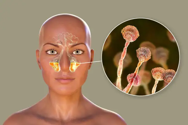 Photo of Aspergillus fungi as a cause of sinusitis. 3D illustration