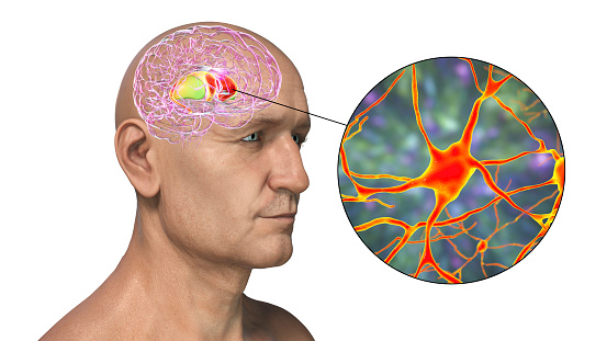 Dorsal striatum highlighted in human brain and close-up view of its neurons, 3D illustration. It is a nucleus in the basal ganglia, a component of the motor and reward systems