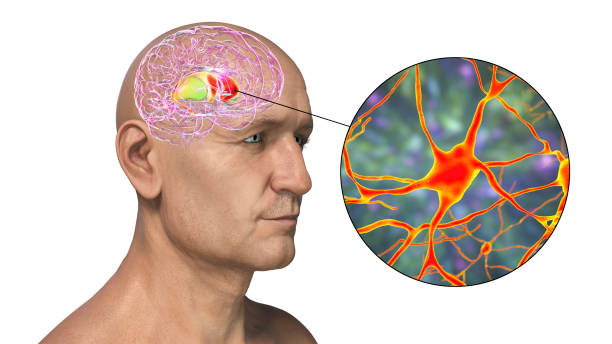 dorsal striatum highlighted in human brain and close-up view of its neurons - corpus striatum imagens e fotografias de stock