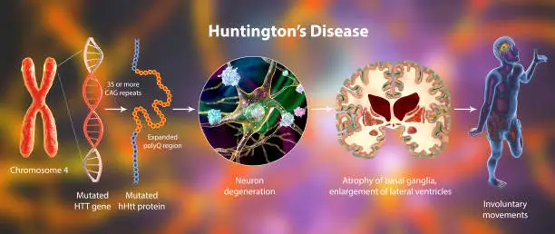 Molecular genesis of Huntington's disease, 3D illustration. Expansion of the CAG trinucleotide sequence in the htt gene causes production of mutated Huntingtin protein leading to neurodegeneration