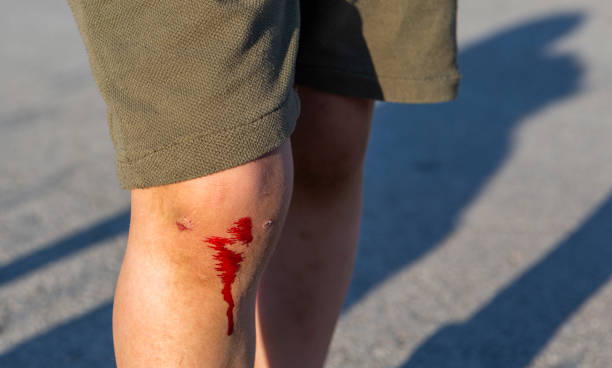 istock The child fell and broke his knee 1325935211