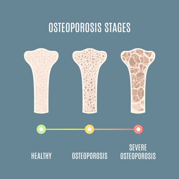 illustrations, cliparts, dessins animés et icônes de ostéoporose perte de densité osseuse maladie infographie médicale - col du fémur