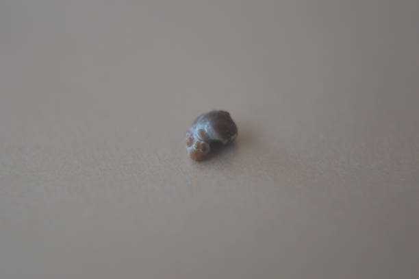 istock Calcium oxalate calculus renal kidney stone 1325969711