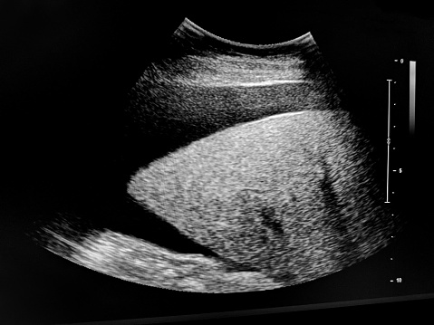 ultrasound examination of the liver. massive ascites.