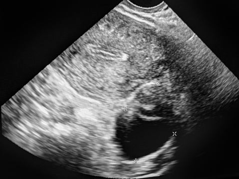 gynecological ultrasound, ovarium cysta