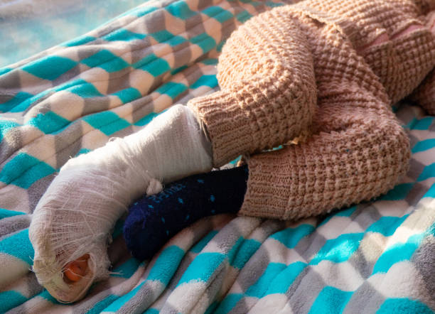 enfant avec bandage sur la fracture du talon de la jambe. pied droit cassé, attelle du bambin. petit boi dormant sur une couverture bleue - physical injury bandage wound cast photos et images de collection