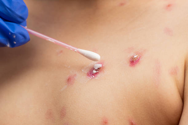 treatment of ulcers from chickenpox, varicella with medical cream treatment of ulcers from chickenpox, varicella with medical cream pox stock pictures, royalty-free photos & images