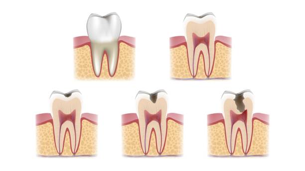Stages of caries vector art illustration