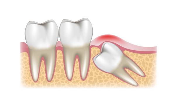 Growing wisdom tooth A schematic sectional view of a growing wisdom tooth wisdom-teeth stock illustrations