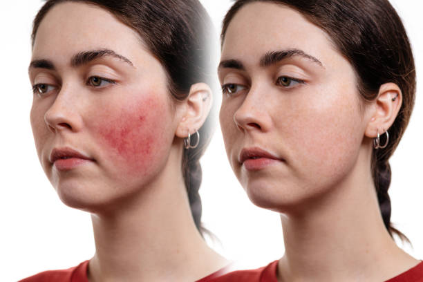 dois retratos de perto de uma jovem caucasiana com rosacea em suas bochechas. antes e depois. fundo branco. o conceito de rosacea e inflamação no rosto - rosácea irritação cutânea - fotografias e filmes do acervo