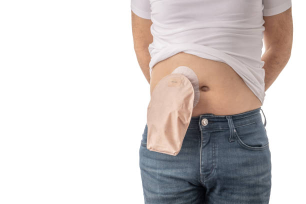 Man wearing a  colostomy bag isolated on white background Man wearing a  colostomy bag isolated on white background colon photos stock pictures, royalty-free photos & images