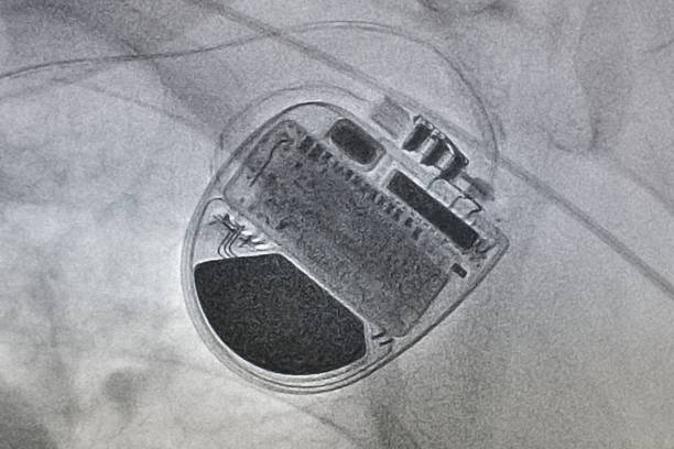 istock x-ray image of permanent pacemaker implant in chest body 1326262282