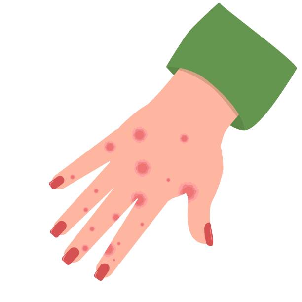 vektordarstellung einer hand mit ekzemen oder kontaktdermatitis, isoliert auf weißem hintergrund - toxicodermatitis stock-grafiken, -clipart, -cartoons und -symbole