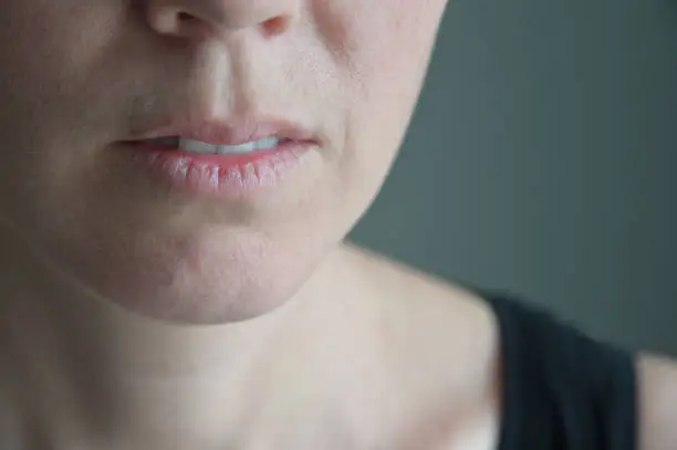 Adult woman suffers from a very dry lips.
