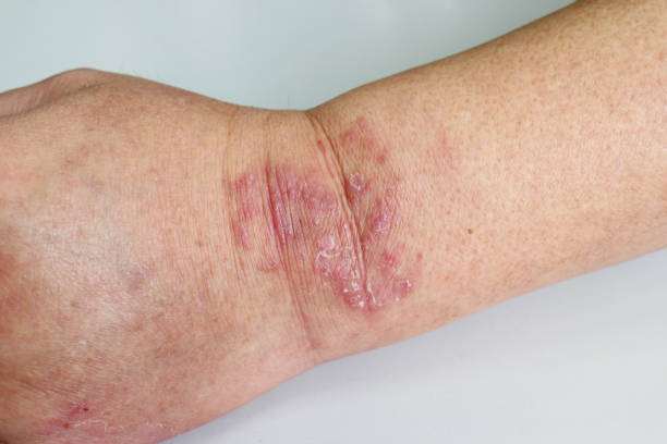 istock Skin disease of the wrist 1326418053