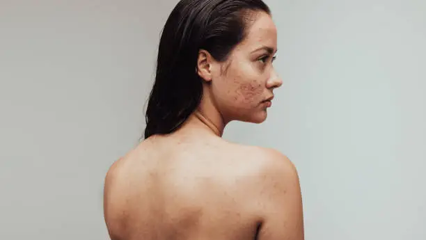 Portrait of woman having acne inflammation on face and body. Rear view close up of woman with pimples on face.