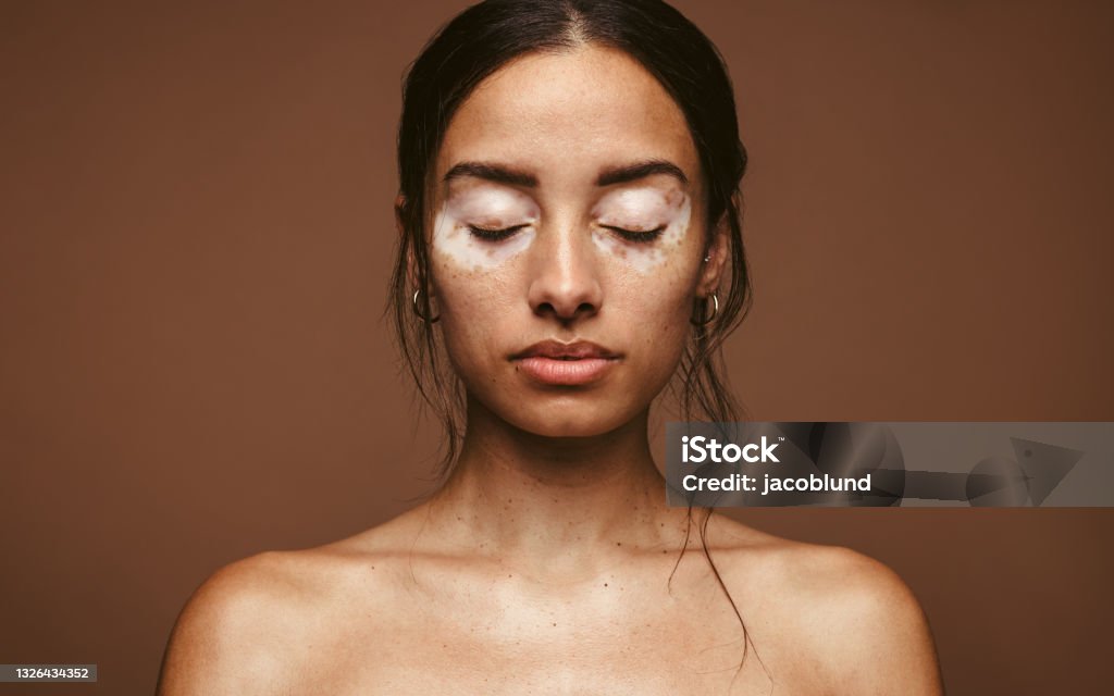 Embrace your skin condition Portrait of young woman with vitiligo on brown background. Skin disorders lead to insecurities in women. Vitiligo Stock Photo