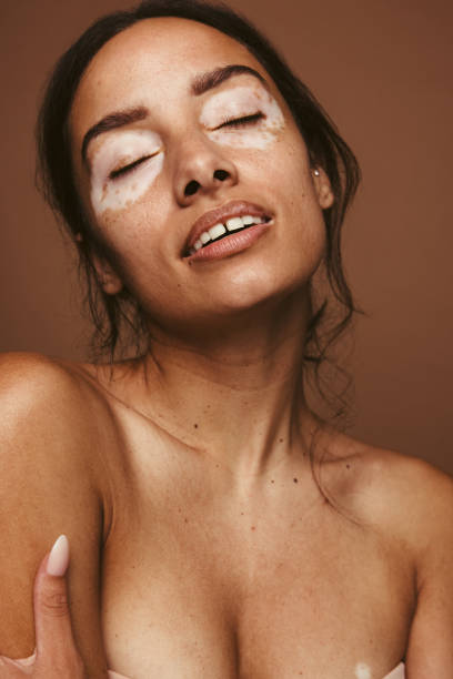 istock Confident woman with vitiligo 1326434364
