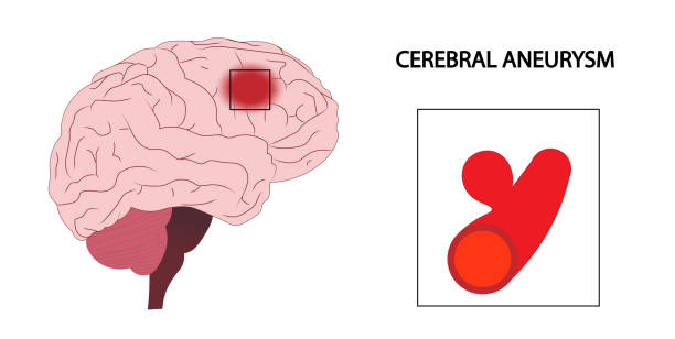 Cerebral Aneurysm. Artery aneurysm illustration Cerebral Aneurysm. Artery aneurysm illustration cerebrum stock illustrations