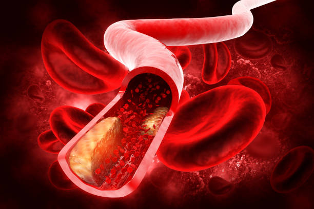 istock Cholesterol plaque in artery.3d illustration 1326580417