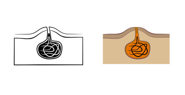 Pilonidal cyst icon vector illustration dimple in cheek stock illustrations
