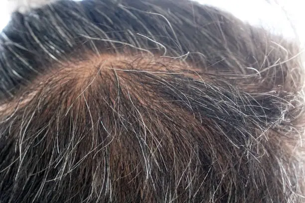 Macro gray-hair or white hoary hair on the head of old man