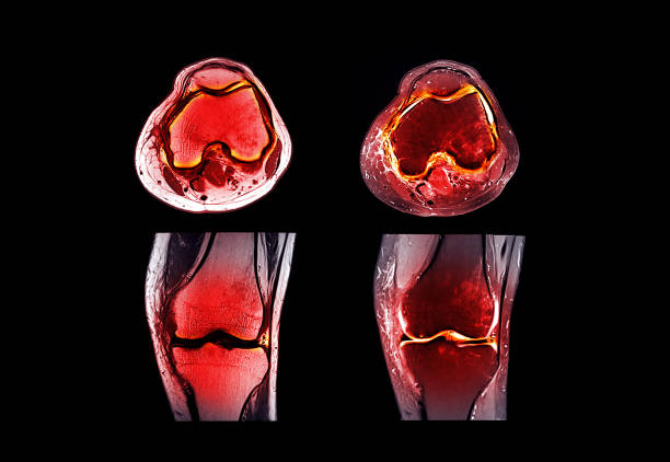 magnetresonanztomographie oder mrt-kniegelenksvergleich koronale und sagittale ansicht zum nachweis von rissen oder verstauchungen des vorderen kreuzbandes (acl) - cruciate ligament stock-fotos und bilder