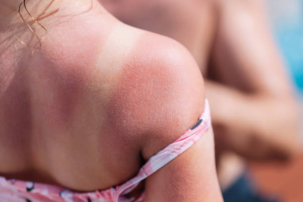 la espalda roja de una niña con una quemadura de sol y líneas blancas de un traje de baño con una piscina de hotel en el fondo - quemado por el sol fotografías e imágenes de stock