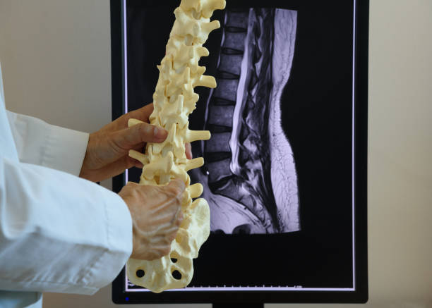 mri 척추 배경에 요추 척추 모델을 들고 있는 의사 - human spine mri scan x ray doctor 뉴스 사진 이미지