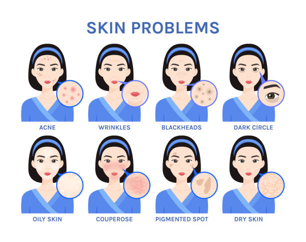 ilustrações, clipart, desenhos animados e ícones de problemas de pele no rosto bonito da garota asiática de perto. acne, rosacea, manchas pigmentadas, círculos escuros, pele seca e oleosa, rugas. estilo de desenho animado de cor plana. fundo branco. ilustração vetorial. - rosácea irritação cutânea