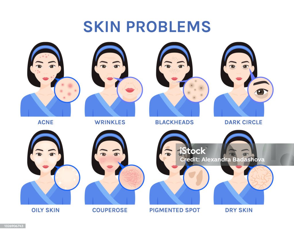 Skin Problems On The Beautiful Face Of Asian Girl Closeup Acne Rosacea  Pigmented Spots Dark Circles Dry And Oily Skin Wrinkles Flat Color Cartoon  Style White Background Vector Illustration Stock Illustration -