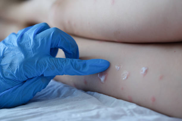 médecin dans des gants en caoutchouc appliquant de la crème sur l’éruption rouge de gros plan de l’enfant - virus pox photos et images de collection