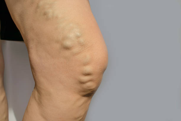varicose veins in the leg varicose veins in the leg varicose vein stock pictures, royalty-free photos & images