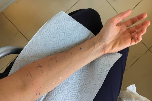 prozess des allergie-hauttests auf der hand des patienten. - allergologe stock-fotos und bilder