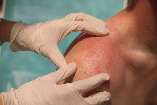 Médico dermatólogo que examina la erupción en la piel de los hombros del hombre usando guantes de cerca photo