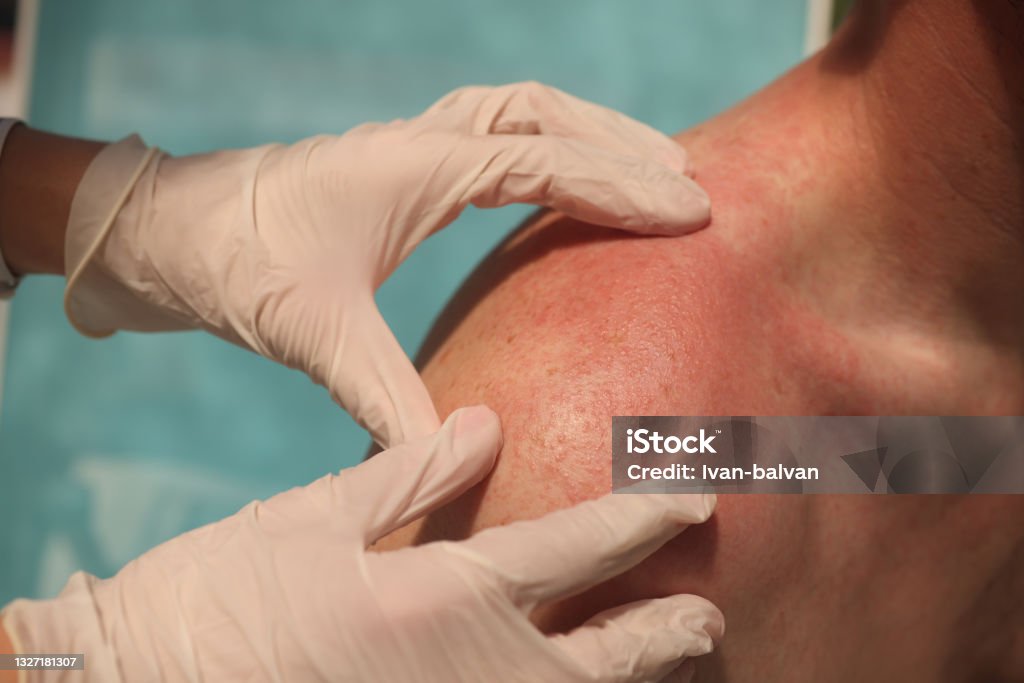 Doctor dermatologist examining rash on skin of man shoulders using gloves closeup Doctor dermatologist examining rash on skin of man shoulders using gloves closeup. Differential diagnosis of allergic and infectious skin diseases concept Sunburned Stock Photo