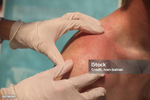 Doctor Dermatologist Examining Rash On Skin Of Man Shoulders Using Gloves Closeup Stock Photo - Download Image Now