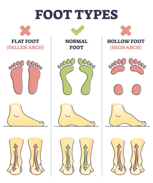 Vector illustration of Foot types with flat, normal and hollow feet comparison in outline diagram