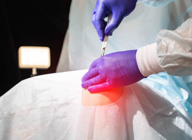 Doctor's hands with a scalpel near the patient's sore knee in the operating room. Knee replacement concept, arthroplasty Doctor's hands with a scalpel near the patient's sore knee in the operating room. Knee replacement concept, arthroplasty. Endoprosthetics artificial knee photos stock pictures, royalty-free photos & images
