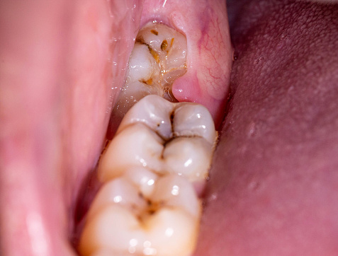 Impacted wisdom tooth due to which a gum hood was formed. Inflammation of the gums due to an unerupted molar, macro, anomaly