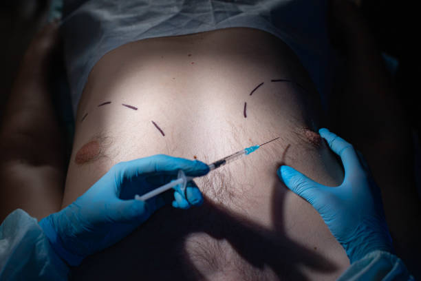 médecin chirurgien plasticien avec une seringue pour corriger le tissu adipeux du sein masculin. réduction du sein masculin de la graisse, gynécomastie - lipolysis photos et images de collection