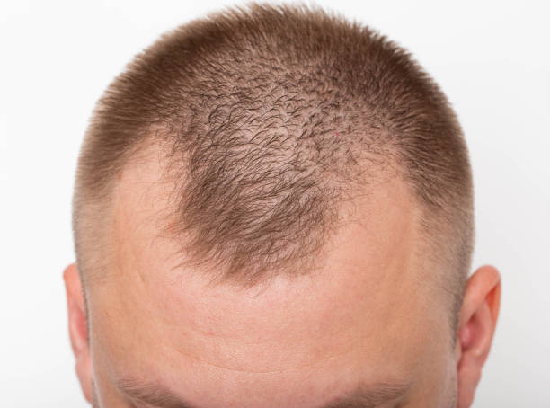 bald patches on the head of a young man. the concept of the increased hormone dihydrotestosterone. weakening of hair follicles - completely bald fotos imagens e fotografias de stock