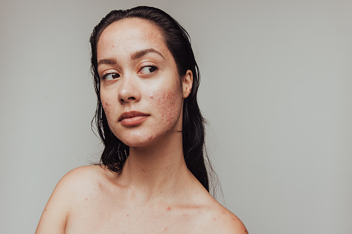 Primer plano de la mujer con inflamación del acné photo
