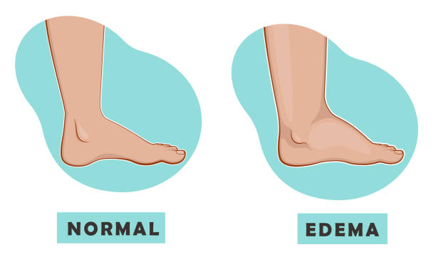 A swollen foot and ankle and a normal foot. Vector illustration A swollen foot and ankle and a normal foot. Vector illustration of the disease swollen stock illustrations