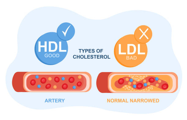 Types of cholesterol in the blood concept Types of cholesterol in the blood concept. High-and low-density lipoproteins. Section of a healthy and narrow artery. Prevention of atherosclerosis. Flat vector illustration on a white background colesterol stock illustrations